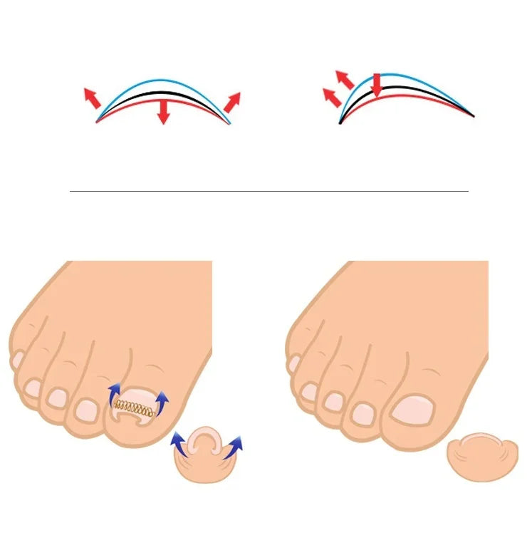 12 in 1 Toenail Orthosis With Ingrown Toenails